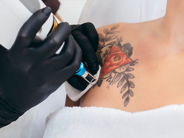 普克尔盒在纹身去除系统中的作用